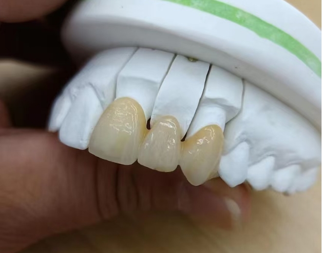 Zirconia-Fused Porcelain Crown
