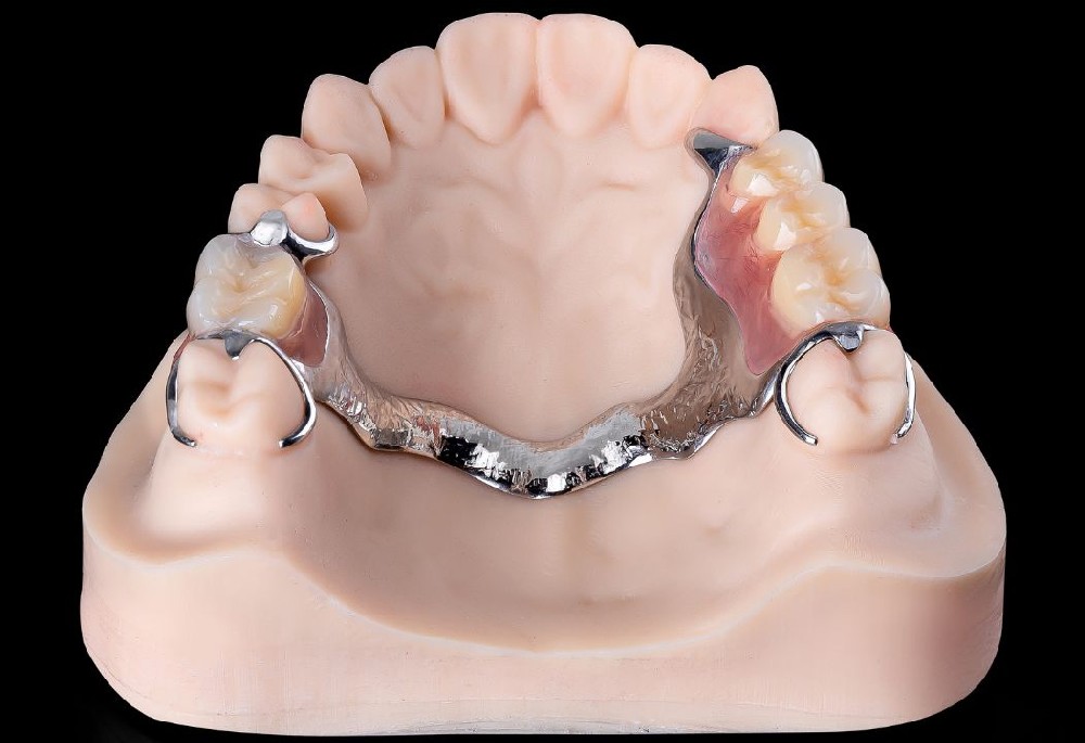 Removable denture with pure titanium metal stent