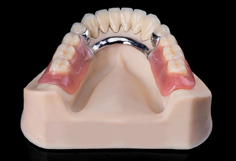 Removable denture with cobalt-chromium metal stent