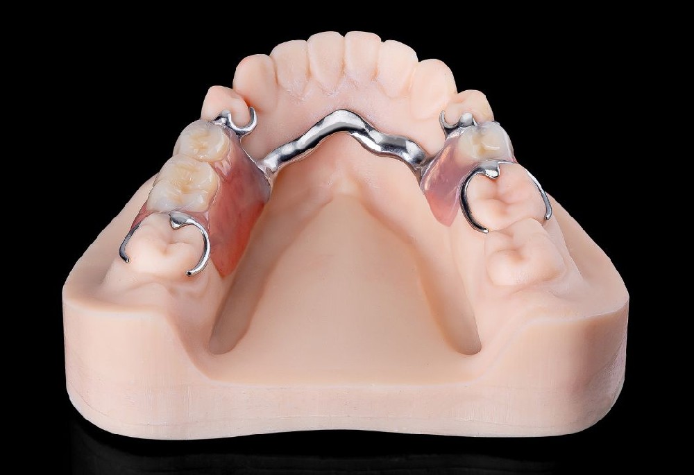 Removable denture with Vitallium stent