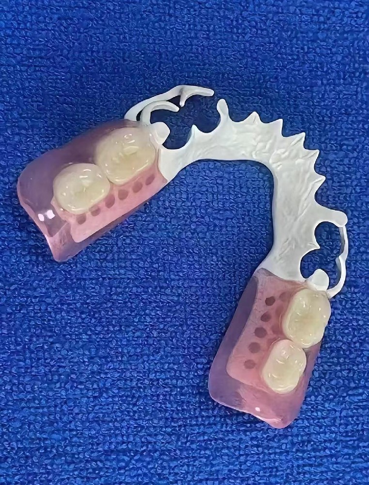 Removable denture with PEEK stent