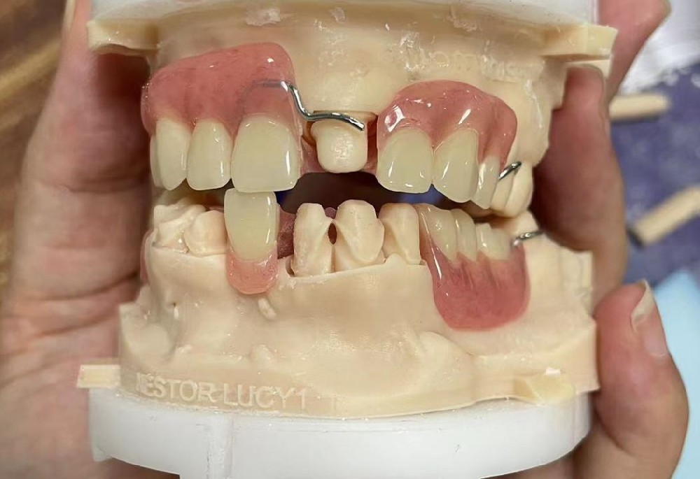 Resin-based removable denture