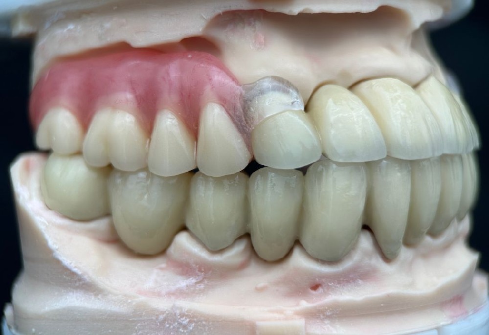 Valplast Clasps