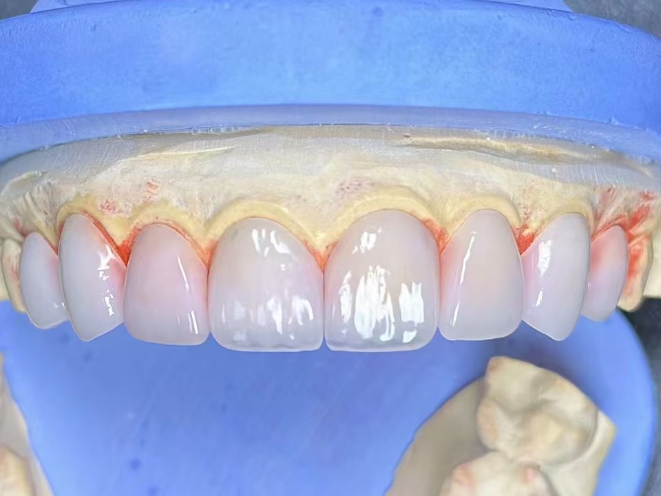 Emax Veneer