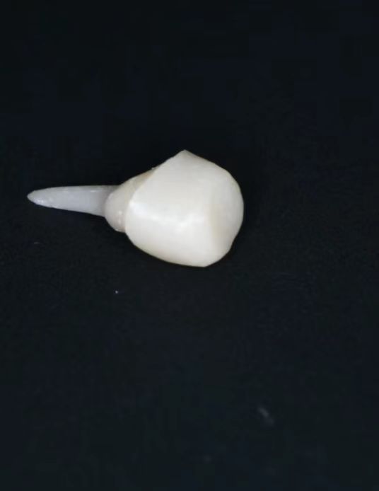 Zirconia Post and Core