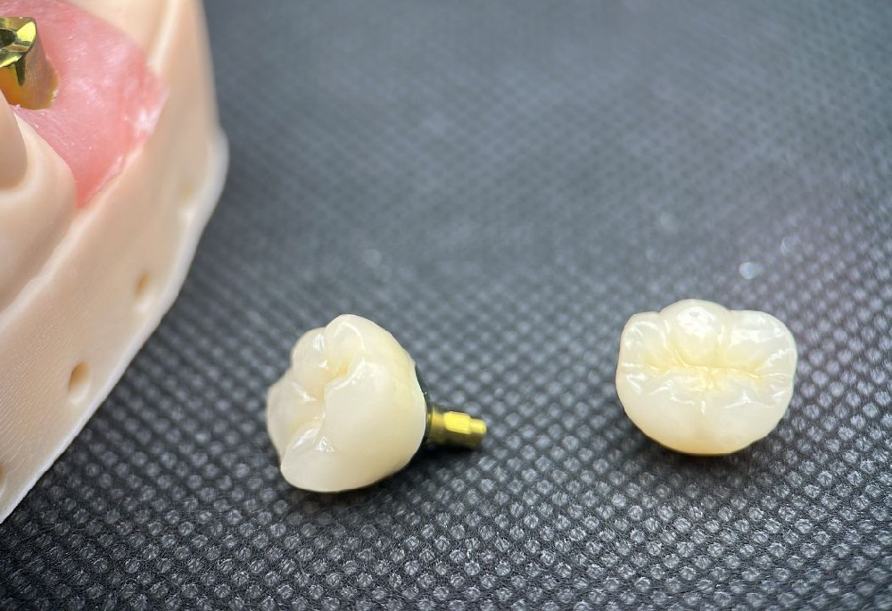 Zirconia Implant Crown