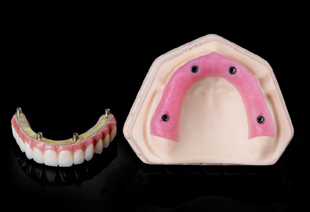 Pure Titanium Metal Bridge + Full Arch Zirconia Crowns