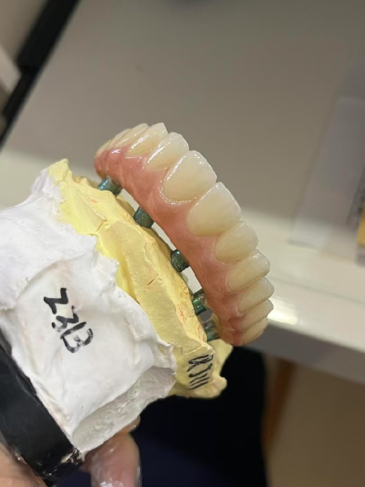 Customized abutment + full-arch Zirconia crown
