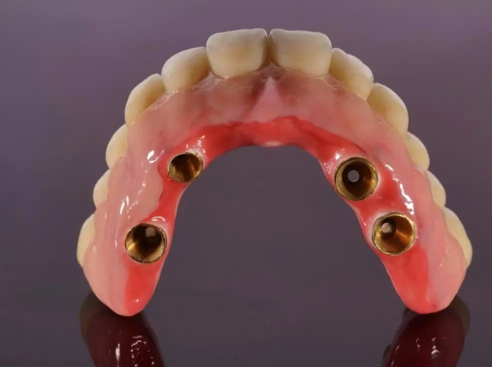 Titanium base + full-arch Zirconia Crown