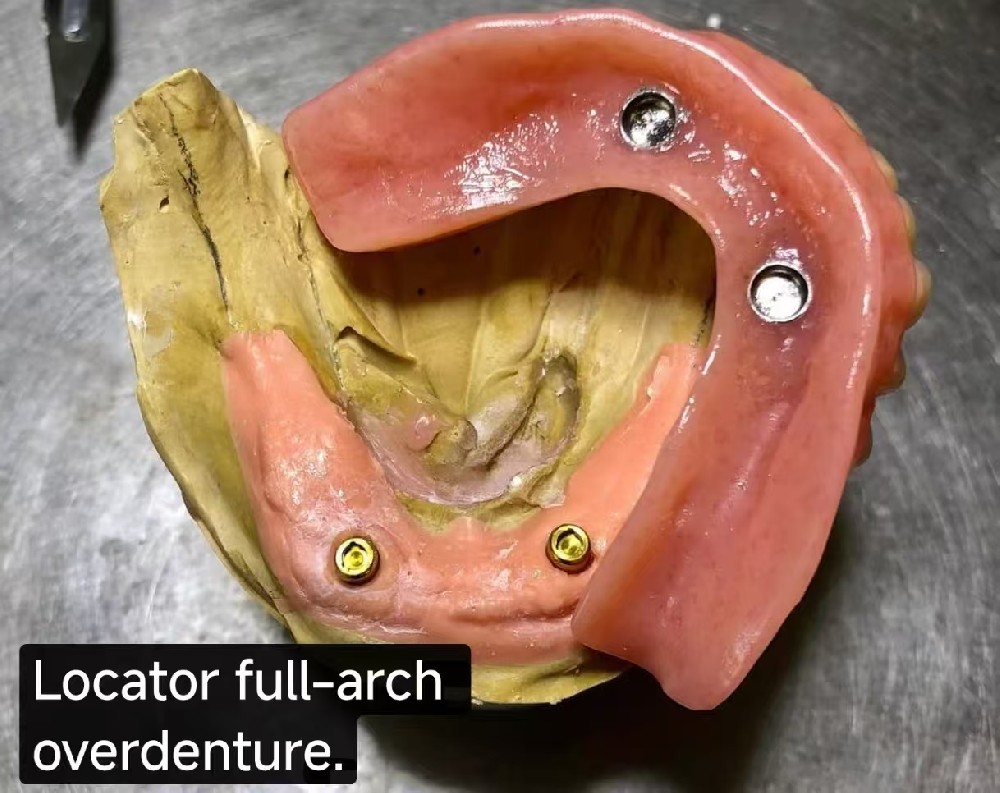 Locator-Supported Overdenture