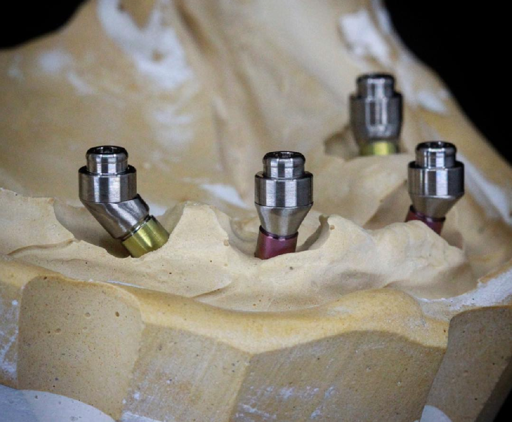 Custom-Milled Locator-Supported Overdenture