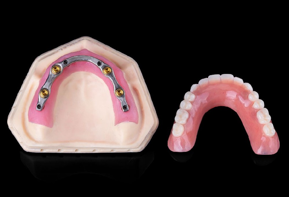 Titanium Bar + Fixed Overdentures