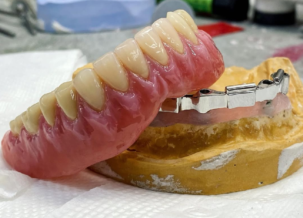 Titanium Bar + Removable Overdentures