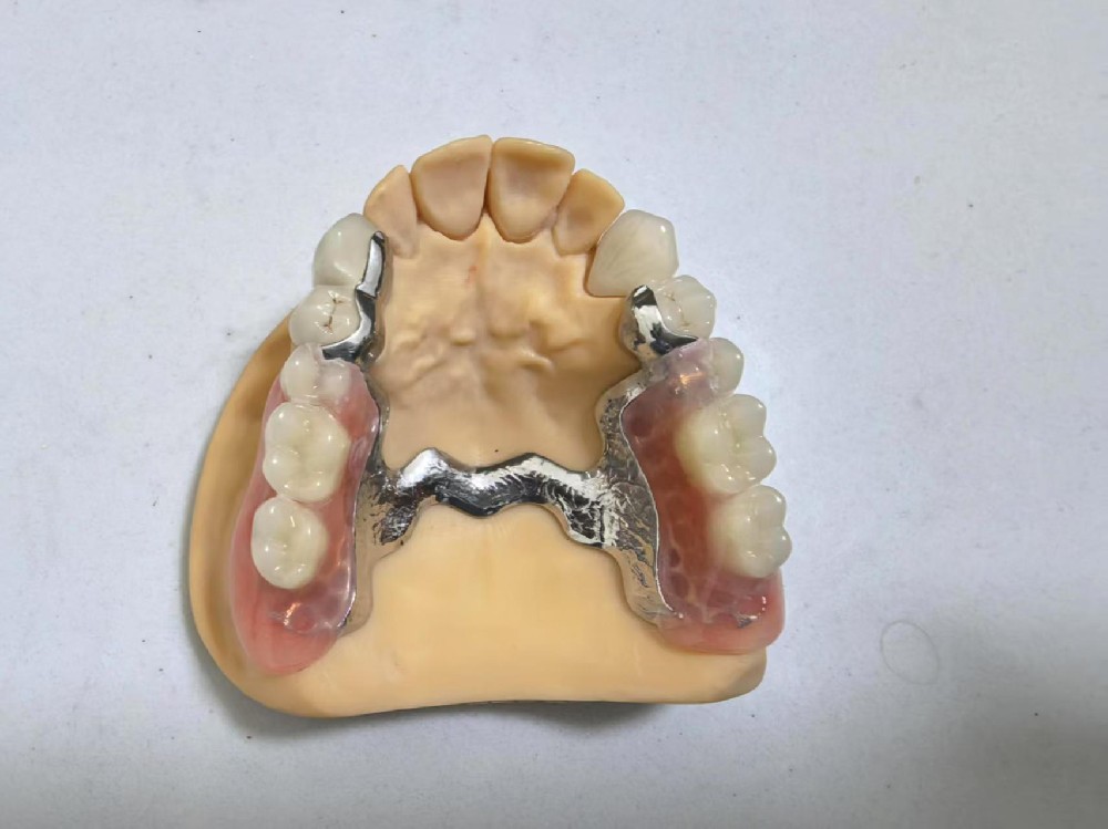 Bar-Type Attachment Dentures