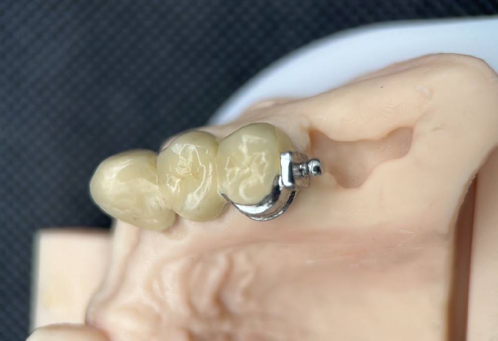 Ball Cap Attachment Dentures