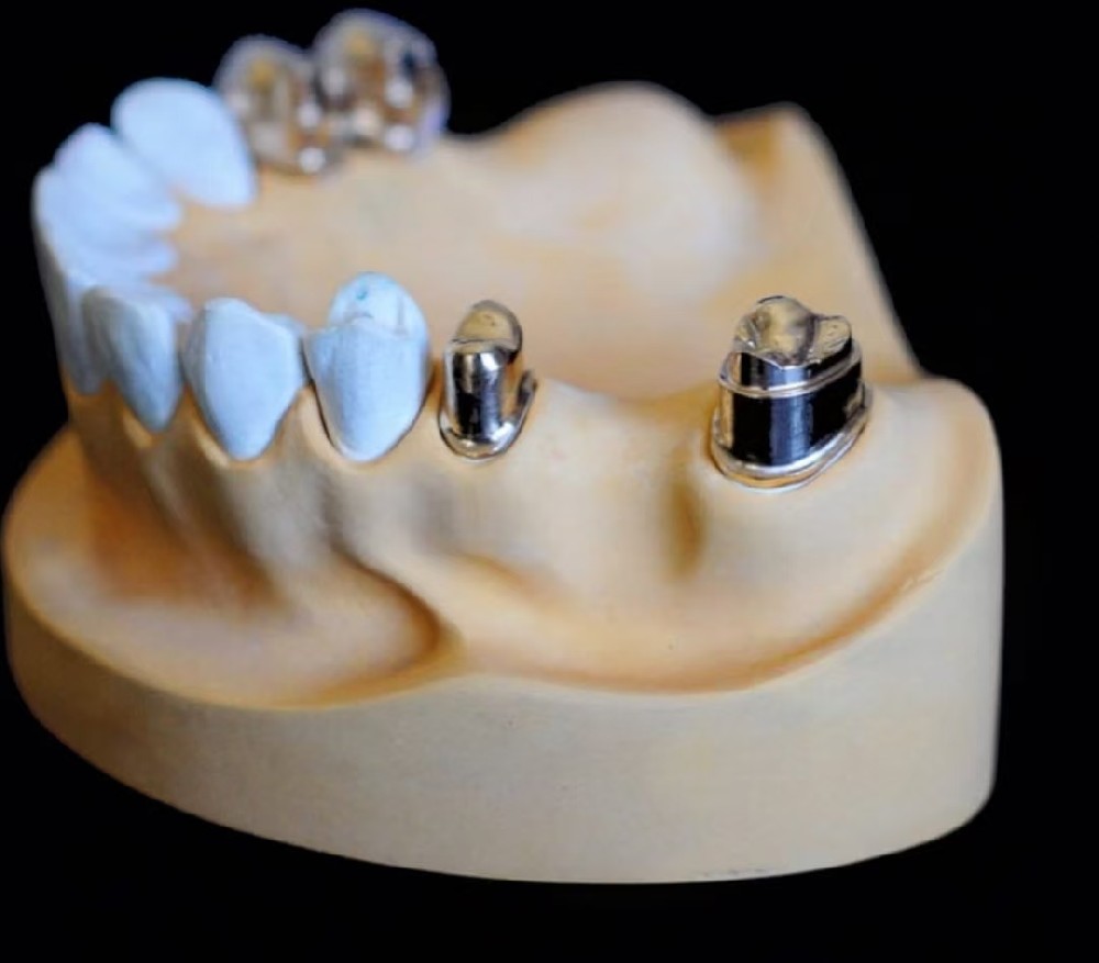 Copings Dentures